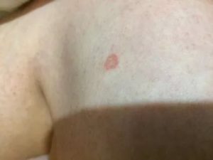 Пятна на теле розового цвета не беспокоят