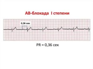 АВ блокада 1 степени