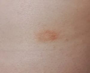 Появились круглые и овальные пятна на коже