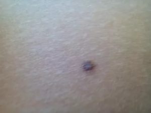 Маленькая родинка стала более выпуклой