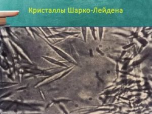 Кристалические образования Шарко-Лейдена