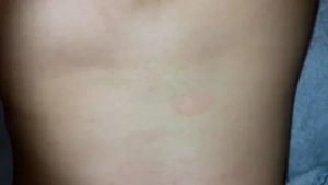 Пятна на теле розового цвета не беспокоят