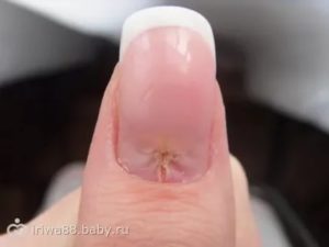 Трещина в ногте от кутикулы к окончанию ногтя