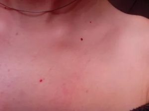 Красные точки на шее и груди