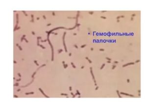 Гемофильная палочка в носу и в зеве