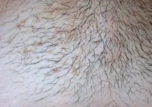 Шелушение и зуд на лобке