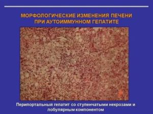 Перипортальные изменения печени