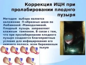Пролабирование плодного пузыря