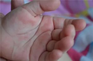 У ребенка чешутся ладони и стопы ног