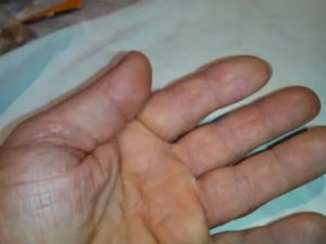 Слазит кожа на ладонях после лечения антибиотиками