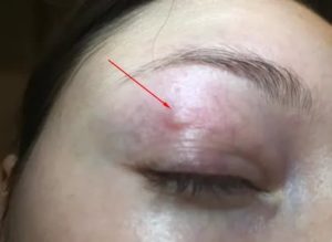 Шишечка под бровью