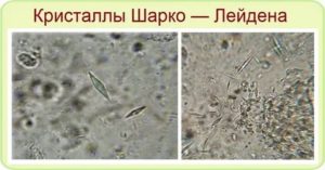 Кристалические образования Шарко-Лейдена