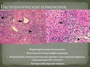 Перипортальные изменения печени