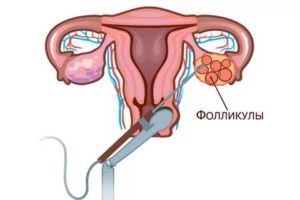 Киста яичников, эко