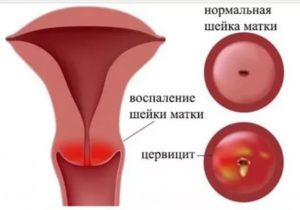 Сильное воспаление шейки при беременности