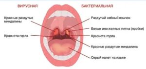 Кровь в горле