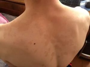 Светло коричневые пятна на спине