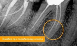 Сильные и продолжительные боли после пломбировки метапексом