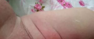 Сыпь под памперсом