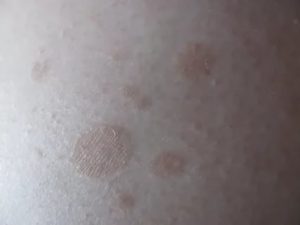 Светло коричневые пятна на спине