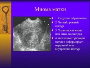 Миома с деформацией полости матки