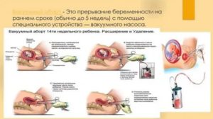 Планирование беременности после прерывания
