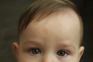 Желтоватые пятна на лбу ребенка
