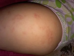Красные, шелушащиеся пятна на попе ребенка