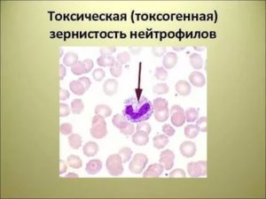 Токсогенная зернистость в крови