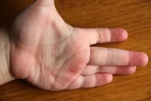 У ребенка чешутся ладони и стопы ног