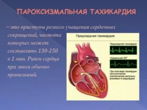 Приступы тахикардии участились