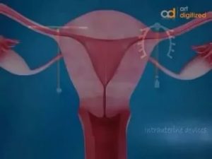 3 месяца после установки спирали тянет живот