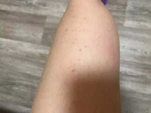 Сыпь выше локтя