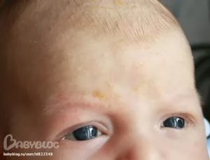 Желтоватые пятна на лбу ребенка