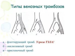Окклюзионный тромбоз, тромбоз ЗББВ
