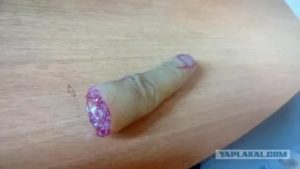 Оторвалась кожа от члена