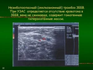 Окклюзионный тромбоз, тромбоз ЗББВ