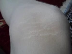 Белая полоса на коже