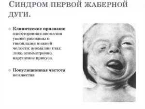 Синдром жаберных дуг и рождение хдорового ребенка