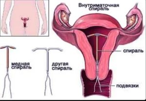 Кровит после спирали