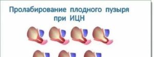 Пролабирование плодного пузыря