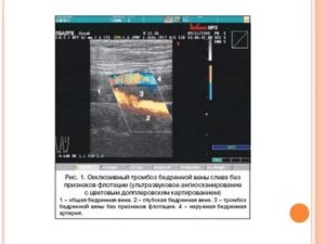 Окклюзионный тромбоз, тромбоз ЗББВ