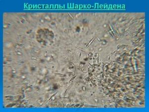Кристалические образования Шарко-Лейдена