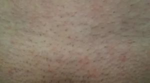 Розовые зудистые пятна на лобке