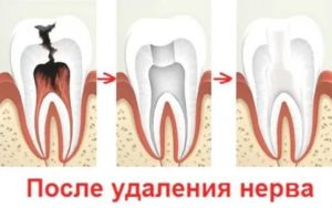 Боль после удаления 46 зуба