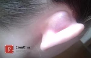 Шишка возле уха, при нажатии болит