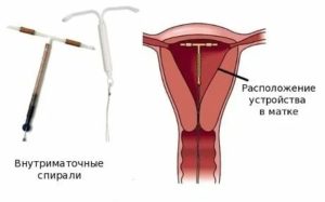 3 месяца после установки спирали тянет живот