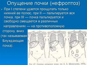 Опущение почки у ребенка