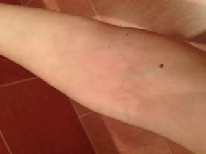 Красное пятно на вене