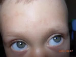 Желтоватые пятна на лбу ребенка